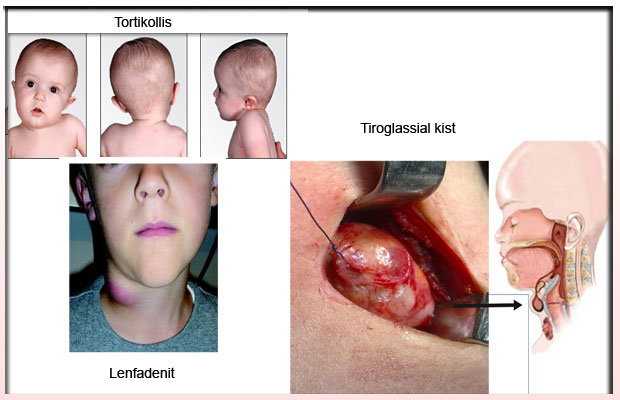 tortikollis, tiroglassial kist, Lenfadenit